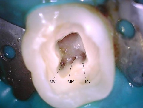 caso clínico molar inferior